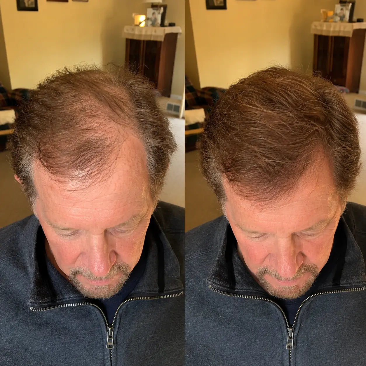 Apex Hair Men before and after results — instant 10 second coverage for thinning hair